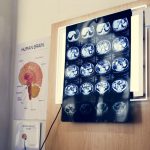 X-rays hanging of a brain of someone who suffers from PTSD