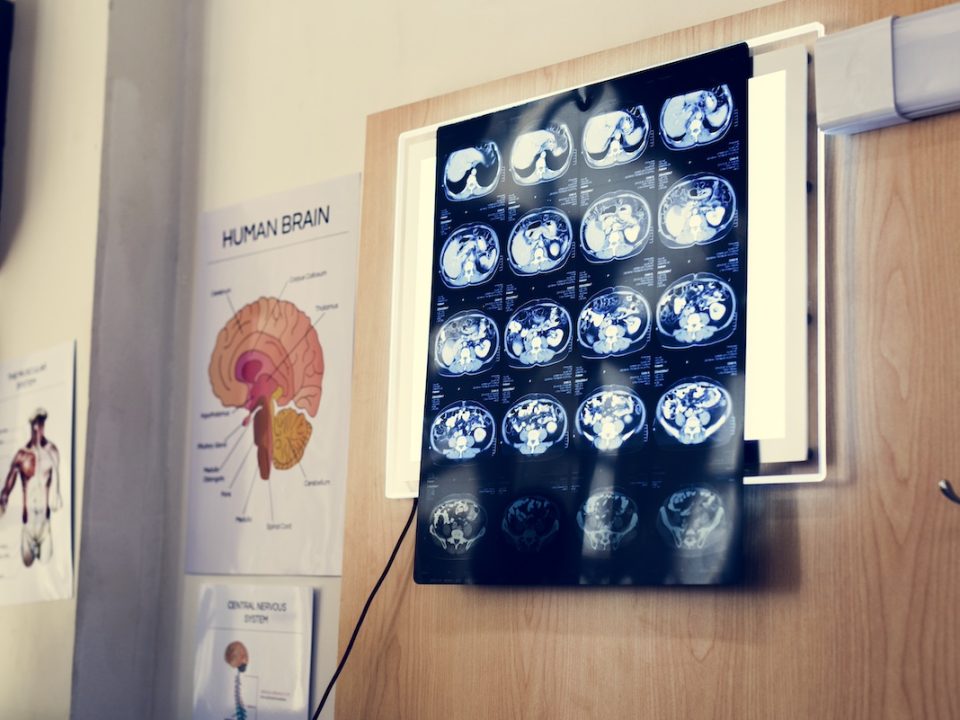 X-rays hanging of a brain of someone who suffers from PTSD
